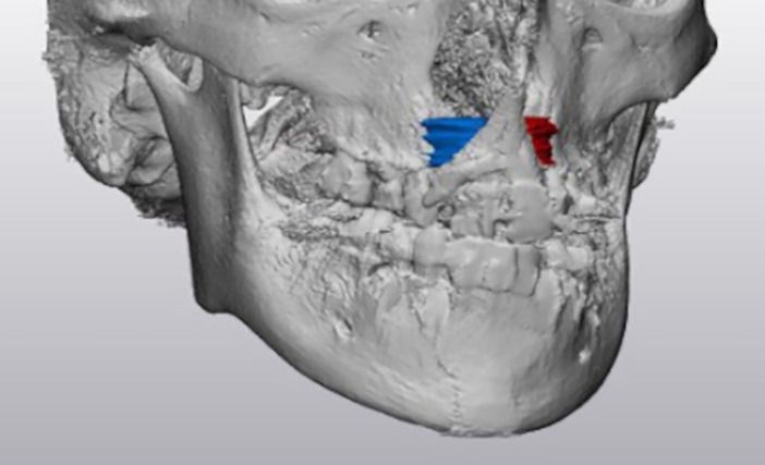 Autogenous Bilateral Cleft Alveolar Bone Grafting with rhBMP-2 and Cellular Bone Matrix.