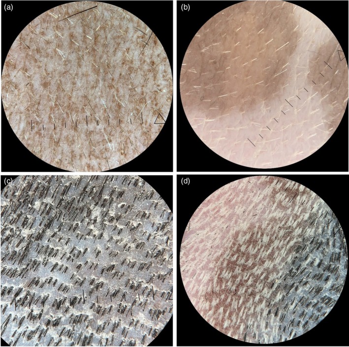 Dermoscopic evaluation of normal canine skin with a handheld dermoscope.