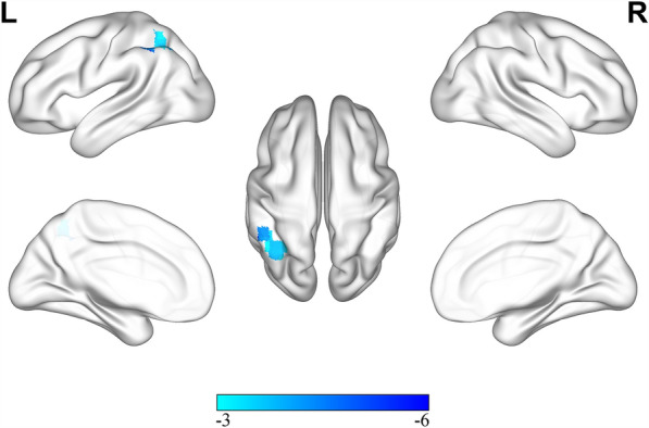 Altered Cortical Gyrification, Functional Connections, and Underlying Neurotransmitter Information in Patients with Parkinson's Disease with Levodopa-Induced Dyskinesia.