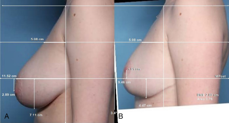 A Review of Mammaplasties With Measurements: Evaluating Autoaugmentation, Mesh, Acellular Dermal Matrix, and the Wise Pattern.