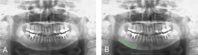 Radiomics-based classification of medication-related osteonecrosis of the jaw using panoramic radiographs.