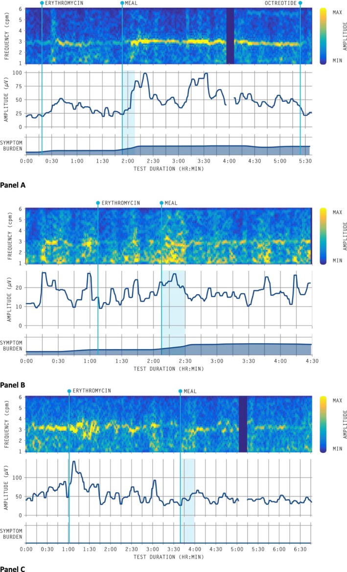Neuropathic Gastroduodenal Disorders Can Be Diagnosed by Non-Invasive Body Surface Gastric Mapping: A Comparison With Antroduodenal Manometry.