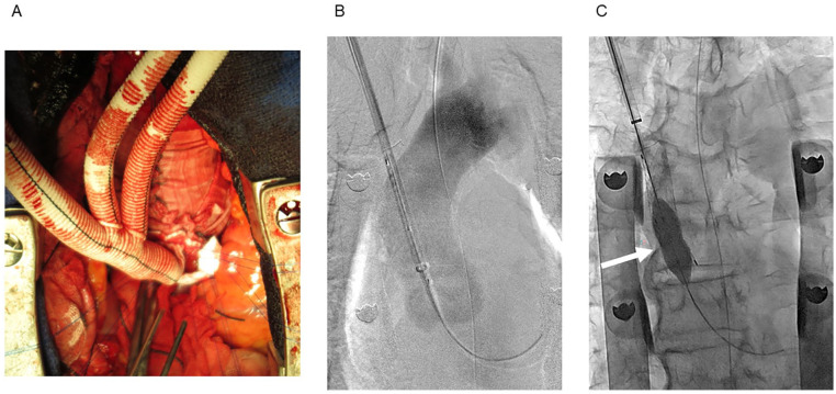 Outcomes of Clampless Real Chimney Technique with Dacron Graft and Sleeve Banding of the Ascending Aorta for Total Debranching Endovascular Arch Repair.