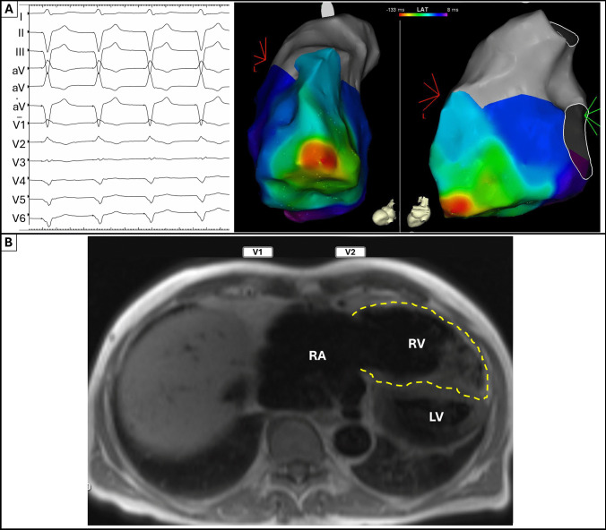 Right bundle branch block pattern with right ventricular pacing in arrhythmogenic right ventricular cardiomyopathy.