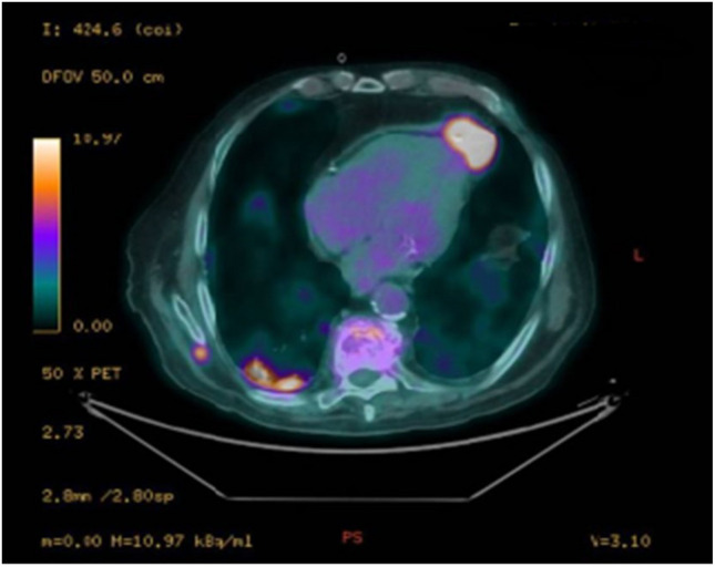 An uncommon complication of a minimally invasive procedure.