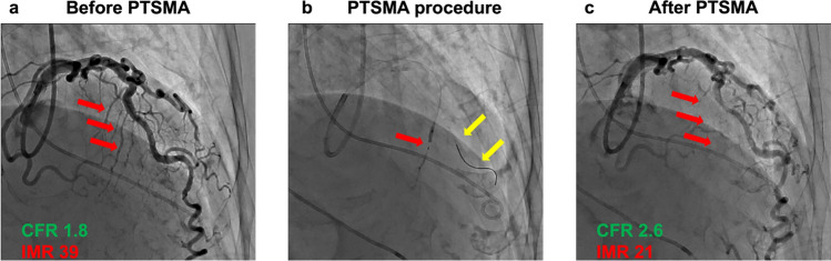 A pilot study on coronary microvascular dysfunction in obstructive hypertrophic cardiomyopathy: impact of percutaneous transluminal septal myocardial ablation.