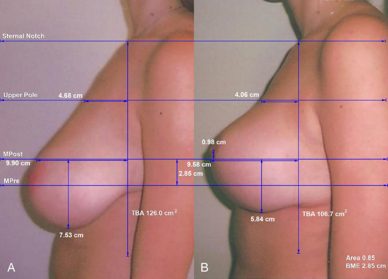 A Review of Mammaplasties With Measurements: Evaluating Autoaugmentation, Mesh, Acellular Dermal Matrix, and the Wise Pattern.