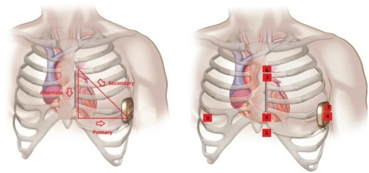 Deep learning-based insights on T:R ratio behaviour during prolonged screening for S-ICD eligibility.