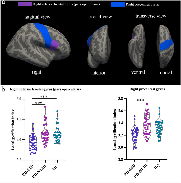 Altered Cortical Gyrification, Functional Connections, and Underlying Neurotransmitter Information in Patients with Parkinson's Disease with Levodopa-Induced Dyskinesia.