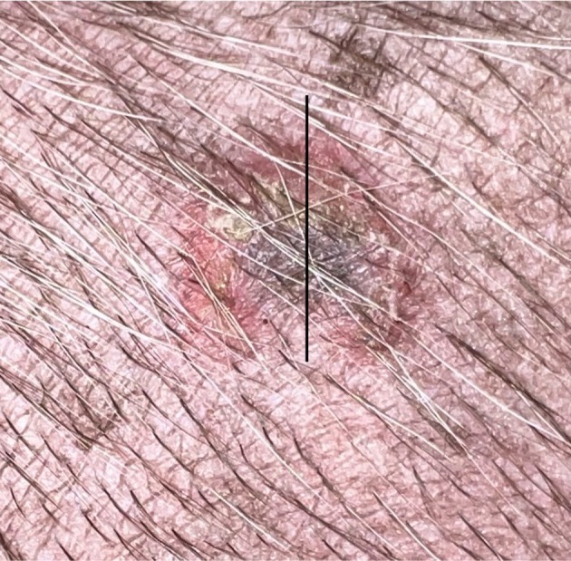Use of saline-soaked bacterial culture swabs increases bacterial recovery in dogs with superficial bacterial folliculitis.