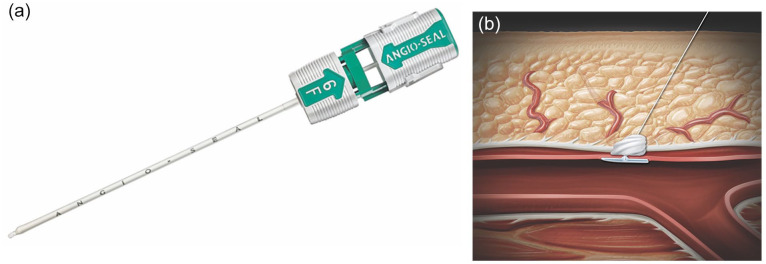 Real-World Experience With the Angio-Seal Closure Device: Insights From Manufacturer and User Facility Device Experience Database.