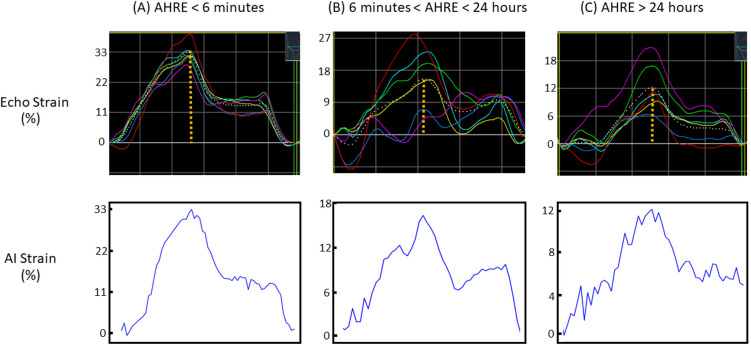 Subclinical atrial fibrillation prediction based on deep learning and strain analysis using echocardiography.