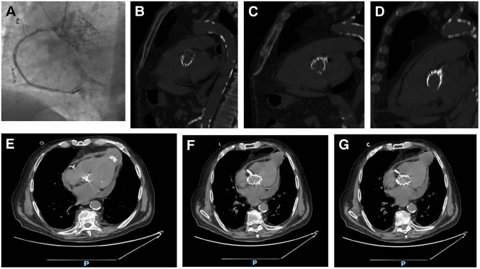 An uncommon complication of a minimally invasive procedure.