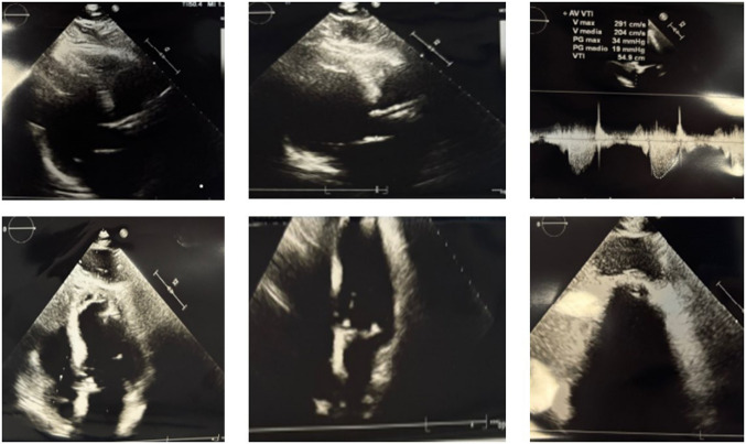 An uncommon complication of a minimally invasive procedure.