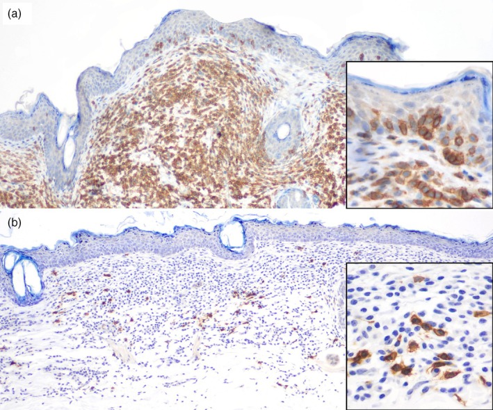 First report of indolent cutaneous T-cell lymphoma in a fennec fox (Vulpes zerda).