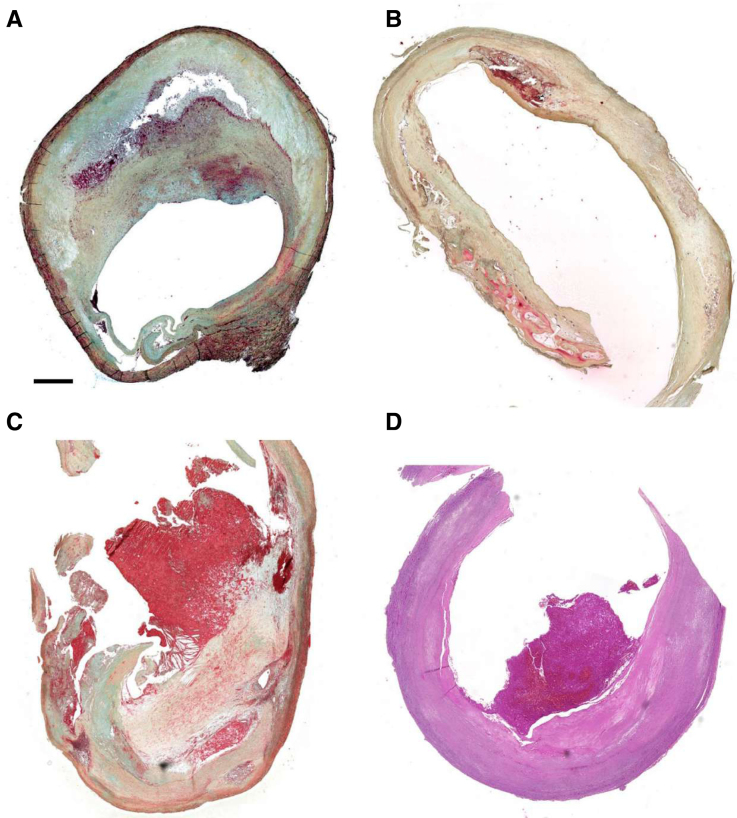 Aging and Sex Modify the Risk of Carotid Plaque Thrombosis Related to Dyslipidemic Profile.
