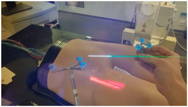 A New Method for Common Femoral Arterial Access Using a Mixed Reality-Assisted Technique on a Phantom Model.