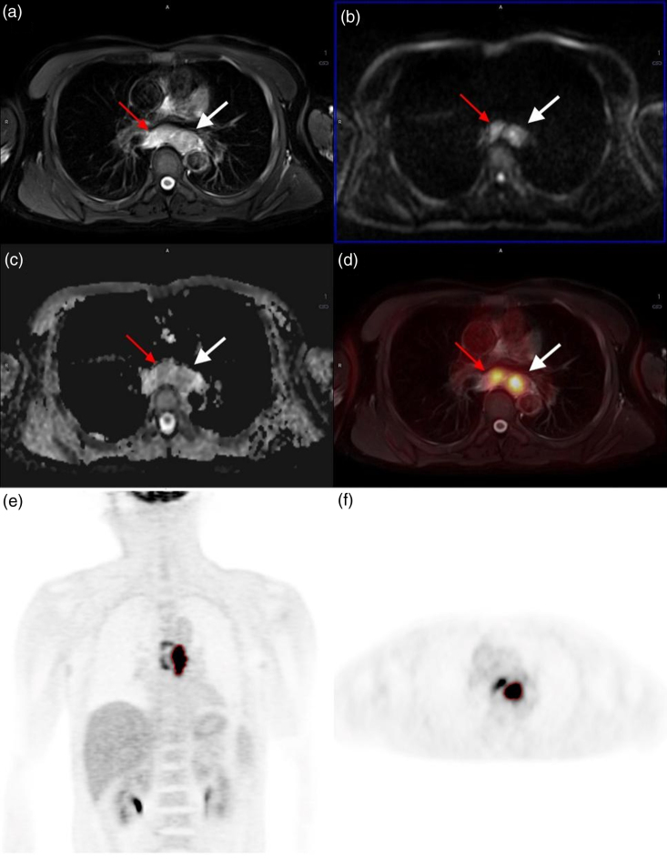 Clinical value of multiparameters of 2-[ 18 F]-fluoro-2-deoxy-glucose PET/MRI in tumor/lymph node staging of esophageal squamous cell carcinoma.