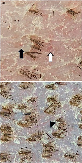 Dermoscopic evaluation of normal canine skin with a handheld dermoscope.