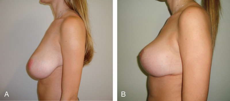 A Review of Mammaplasties With Measurements: Evaluating Autoaugmentation, Mesh, Acellular Dermal Matrix, and the Wise Pattern.