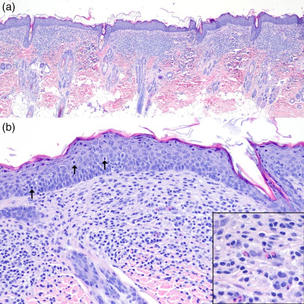First report of indolent cutaneous T-cell lymphoma in a fennec fox (Vulpes zerda).
