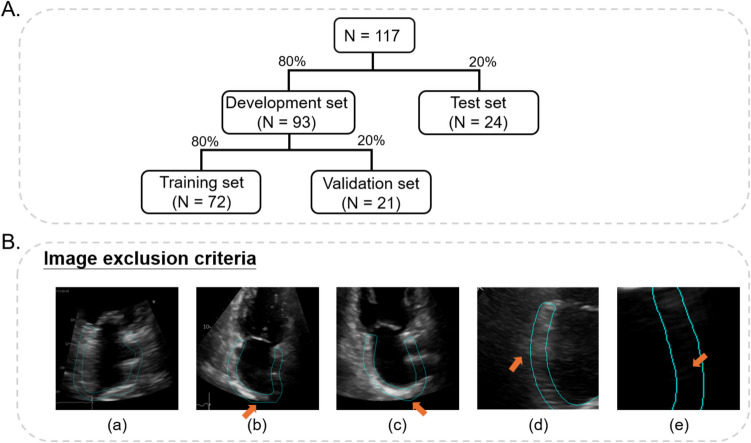 Subclinical atrial fibrillation prediction based on deep learning and strain analysis using echocardiography.