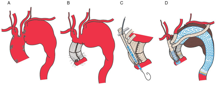 Outcomes of Clampless Real Chimney Technique with Dacron Graft and Sleeve Banding of the Ascending Aorta for Total Debranching Endovascular Arch Repair.