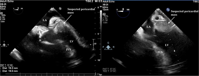 A scenario of left ventricular assist device suction mimicking external compression.