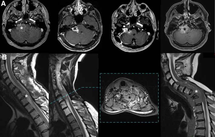A Specific Methylation Class Identifies BAP1-Deficient Meningiomas, Including Meningeal Tumours With Poorly Differentiated Nonrhabdoid Histology.