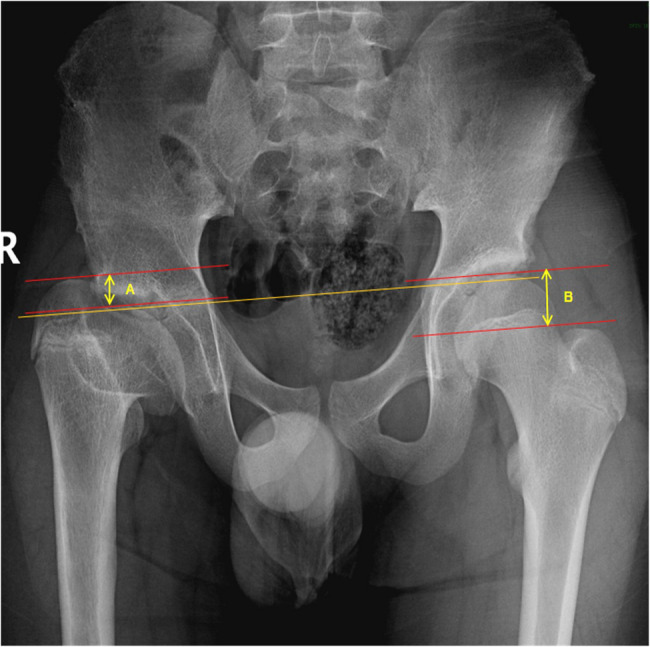 Risk factors associated with greater trochanteric overgrowth secondary to Legg-Calvé-Perthes disease: a retrospective observational study.