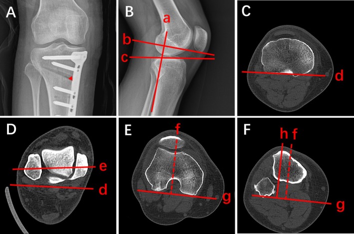 Influence of Alignment Changes in Different Planes During Supra-Tubercular Biplanar Medial Opening Wedge High Tibial Osteotomy on Tibial Tubercle-Trochlear Groove Distance.
