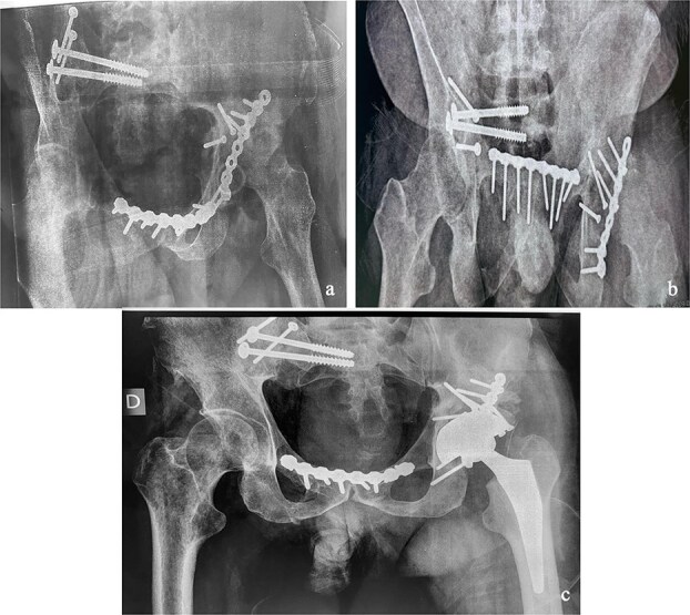 Surgical management of concomitant and delayed complex pelvic and acetabular fractures.