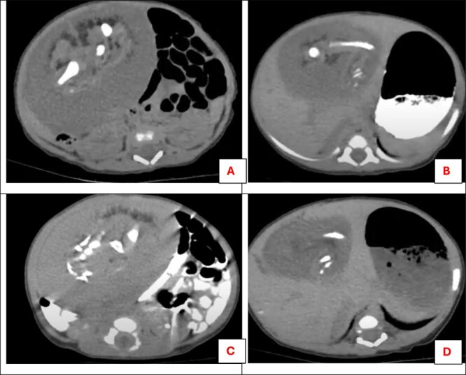 Fetus-in-fetu in an 11-day-old female infant with descriptive histopathological insights: a case report.