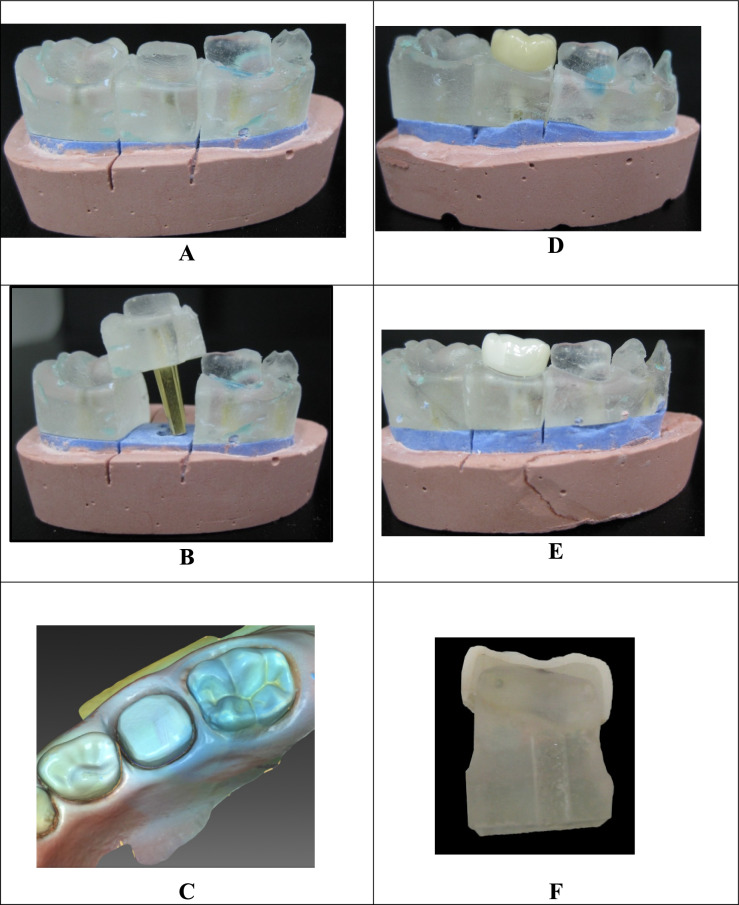 In vitro comparison of marginal fit between CAD/CAM hybrid ceramic crowns and prefabricated zirconia crowns for primary molars.