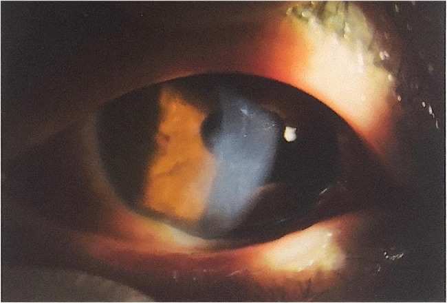 The ocular frostbite involving cornea caused by low-temperature environment.