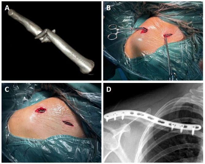 Clinical outcomes of minimally invasive plate osteosynthesis in the management of displaced midshaft clavicle fractures: a case-control study.