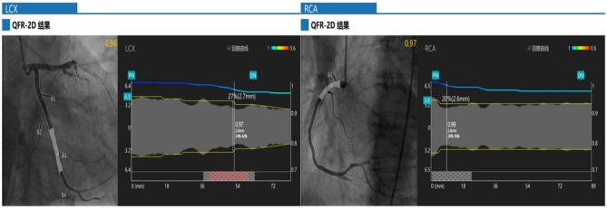 Effects of SGLT2 inhibitors on angiography-derived coronary microcirculatory resistance and clinical outcomes in patients with coronary heart disease and type 2 diabetes: A cohort study.