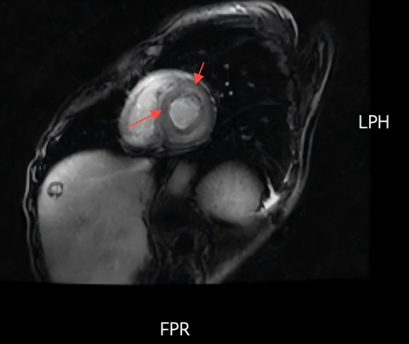 Amyloid cardiomyopathy presenting with gastrointestinal symptoms of abdominal pain, back pain, and constipation: A case report.