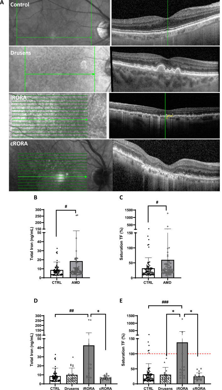 Transferrin is a drug candidate for the treatment of dry age-related macular degeneration (AMD).
