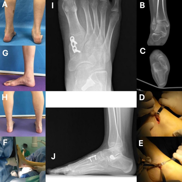 Coalition Resection and Extra-Osseous Talotarsal Stabilization for Talocalcaneal Coalition With Pes Planus Deformity: A Retrospective Study.