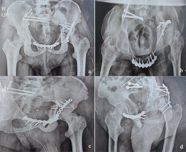 Surgical management of concomitant and delayed complex pelvic and acetabular fractures.