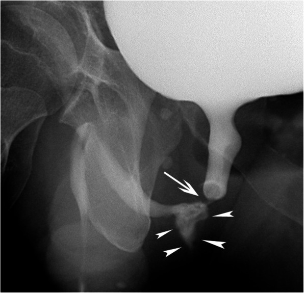 Posttraumatic urethral hemorrhage associated with an arteriospongious fistula and managed with catheter-directed embolization: a report of 2 cases.
