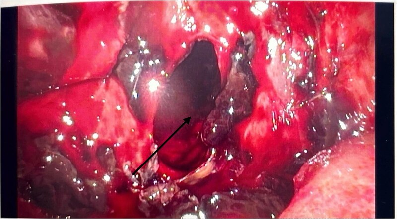 Unseen crisis: the unexpected face of acute haemorrhagic pancreatitis.