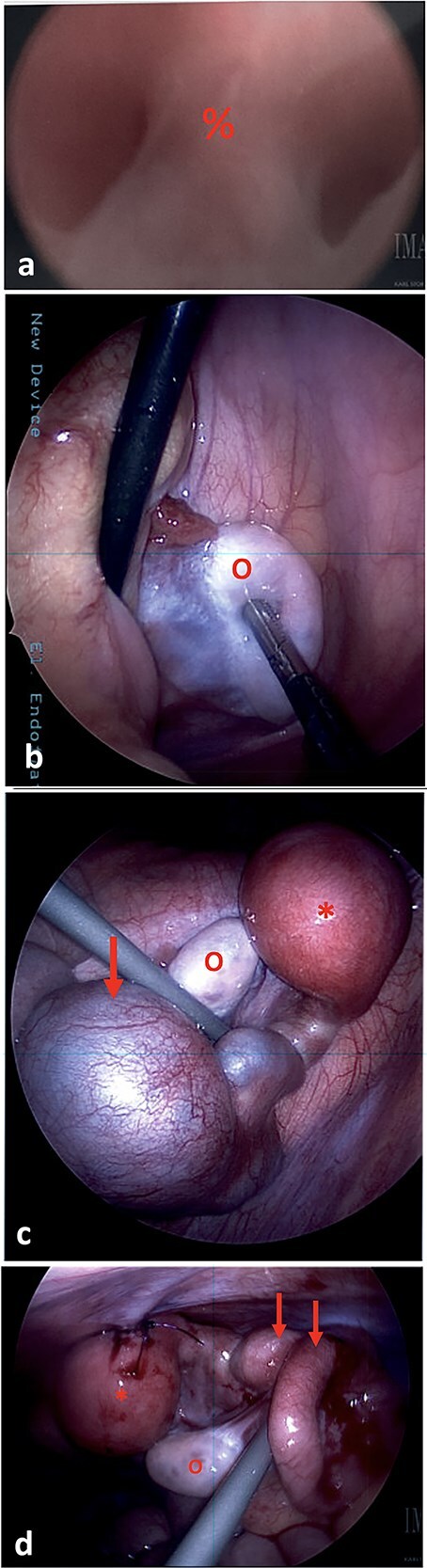 Mayer-Rokitansky-Küster-Hauser syndrome complicated by hematometra and hematosalpinx treated with laparoscopic uterine drain placement: a case report.