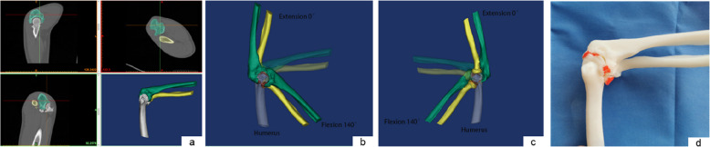 Value of preoperative blocked bone visualization marking on arthroscopic arthroplasty for degenerative elbow stiffness: minimum three-year follow-up.