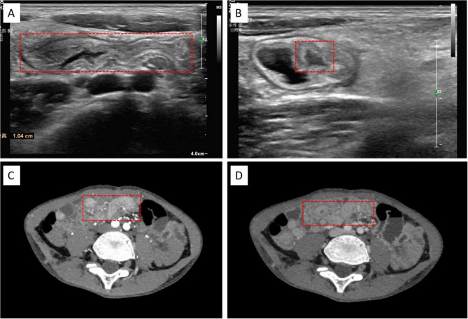 Laparoscopic-assisted resection of long-segment small bowel duplication: a rare case report and review of literature.
