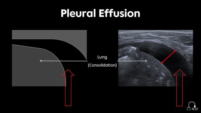 Pleura-ABCDE - a structured expert-based protocol for neonatal lung ultrasound documentation and interpretation.