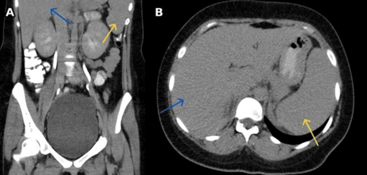 Adult-Onset Still's Disease Presenting as Antibiotic-Refractory Sepsis.