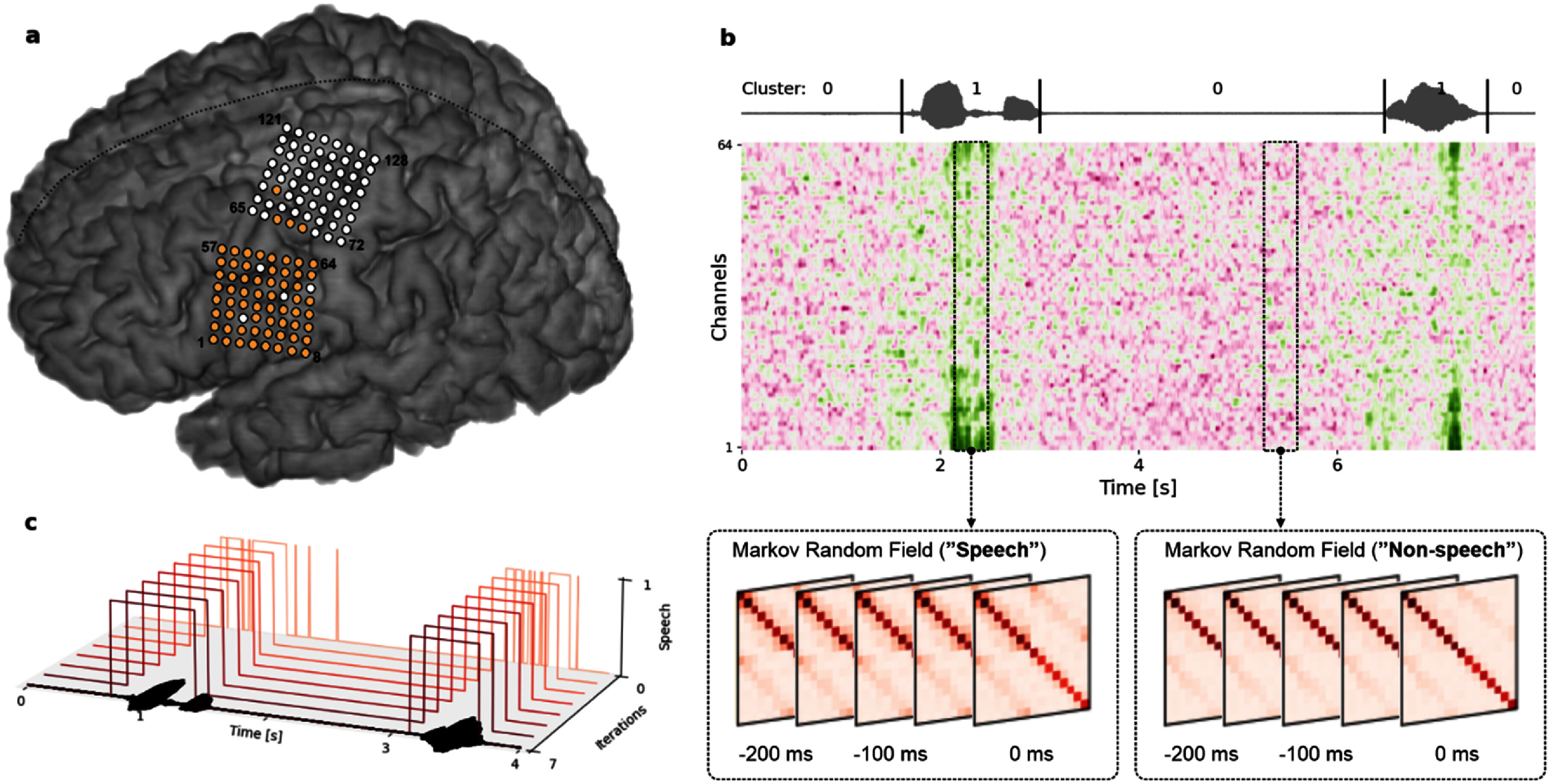 Real-time detection of spoken speech from unlabeled ECoG signals: a pilot study with an ALS participant.