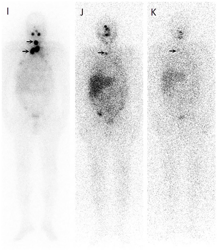 Gluteal Muscle Metastasis of Papillary Thyroid Cancer with Increased Somatostatin Receptor Expression in <sup>68</sup>Ga-DOTATATE PET/MRI.